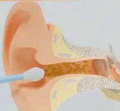 Öronvax Rengörare